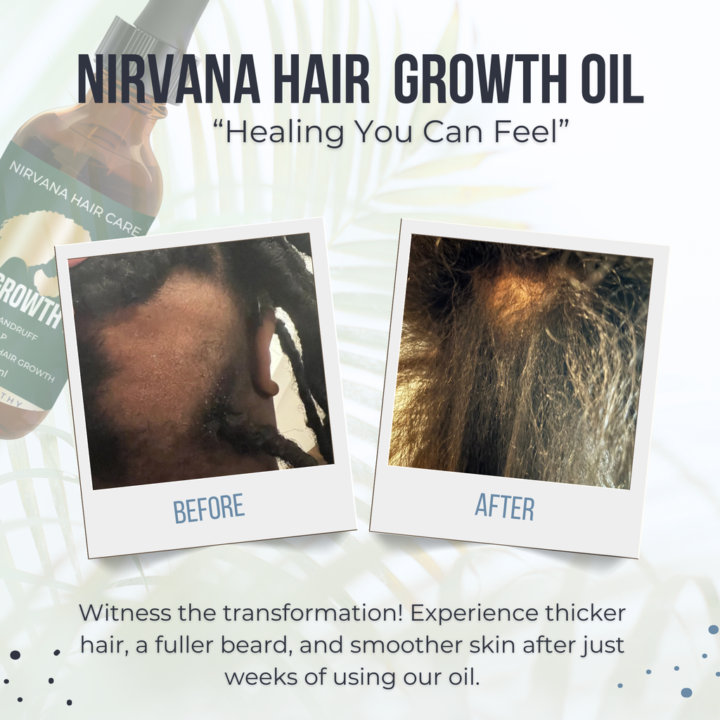 Hair Growth Oil For Dandruff and Scalp Issues